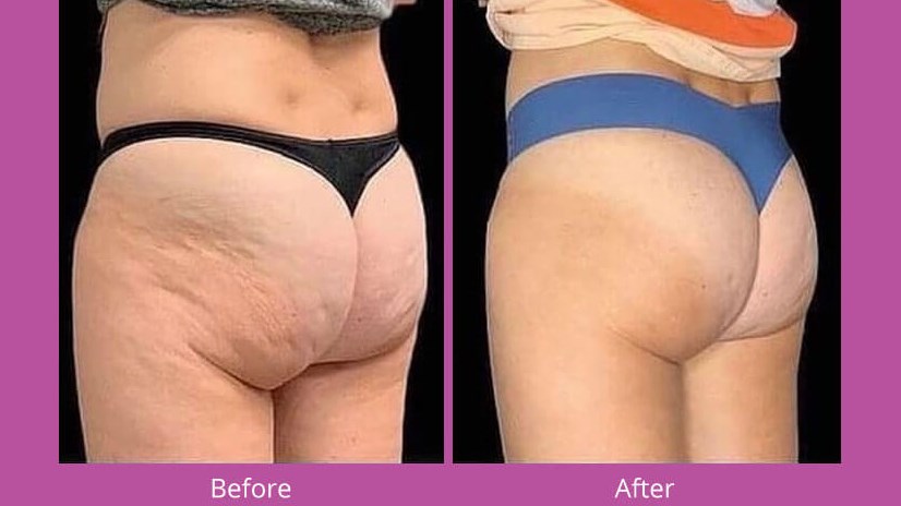 bum lift and cellulite reducti